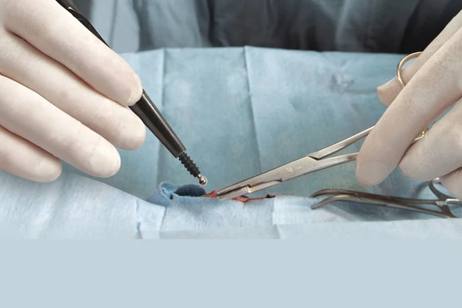 کنترل خونریزی با روش Buzzing Forceps در جراحی